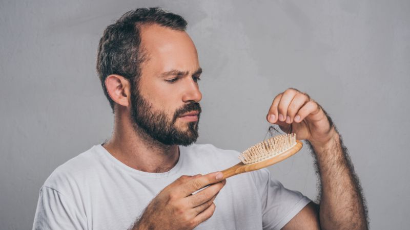 hombre caída del cabello