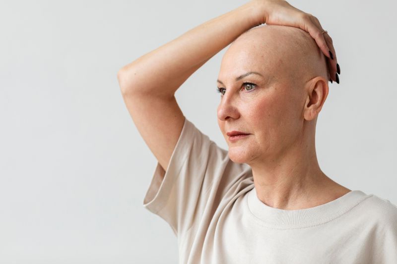 alopecia feminina